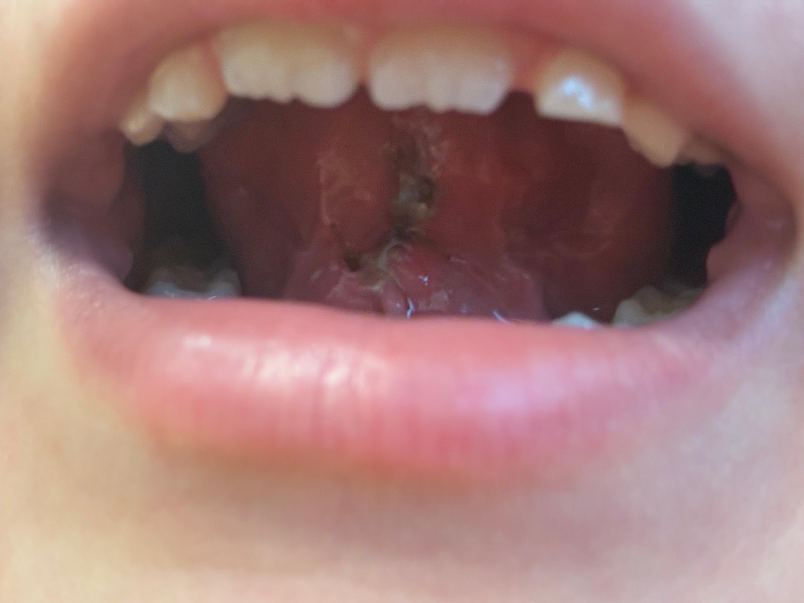Lengua post cirugía realizada por cirujano maxilofacial